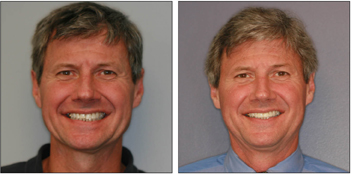 Veneers and Cosmetic Dentistry from Boston Dentist Dr. Jill Smith