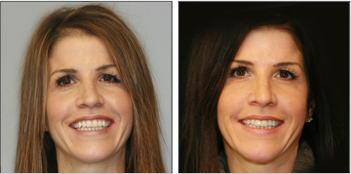 Veneers and Cosmetic Dentistry from Boston Dentist Dr. Jill Smith