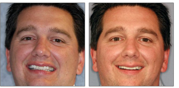 Ceramic Crowns from Boston Dentist Dr. Jill Smith