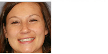 Dental Crowns from Boston dentist Dr. Jill Smith