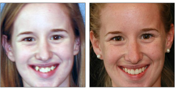 Adult Orthodontics, Invisalign from Boston Dentist Dr. Jill Smith