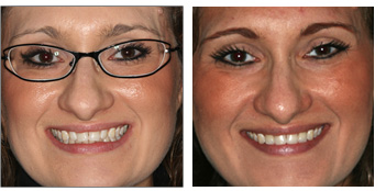 Veneers and Cosmetic Dentistry from Boston Dentist Dr. Jill Smith