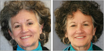 Tooth Crowns from Boston dentist Dr. Jill Smith