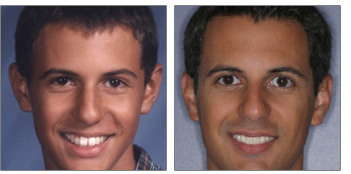 Adult Orthodontics, Invisalign from Boston dentist Dr. Jill Smith