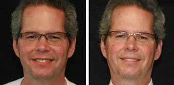 Tooth Crowns from Boston dentist Dr. Jill Smith