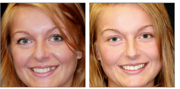 Tooth Replacement from Boston Dentist Dr. Jill Smith