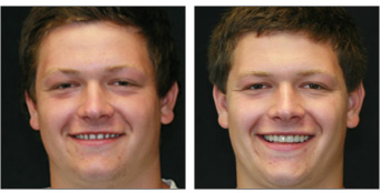 Veneers from Boston Dentist Dr. Jill Smith