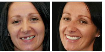 Complex Dental Reconstruction from Boston dentist Dr. Jill Smith